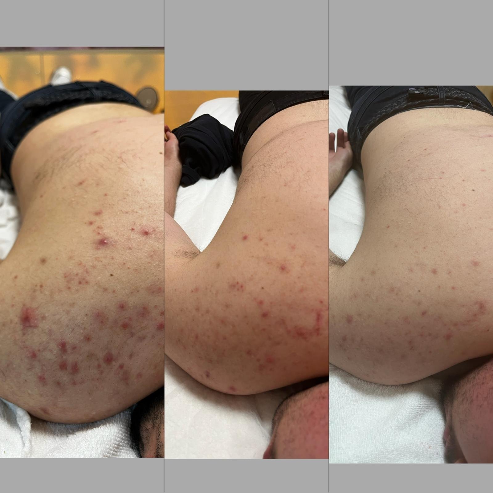 Higiene de Espalda con Tratamiento Dermapen Antiacné