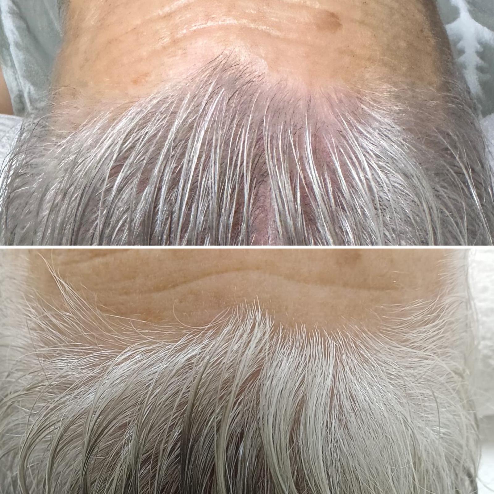 Dermapen Redensificador Capilar