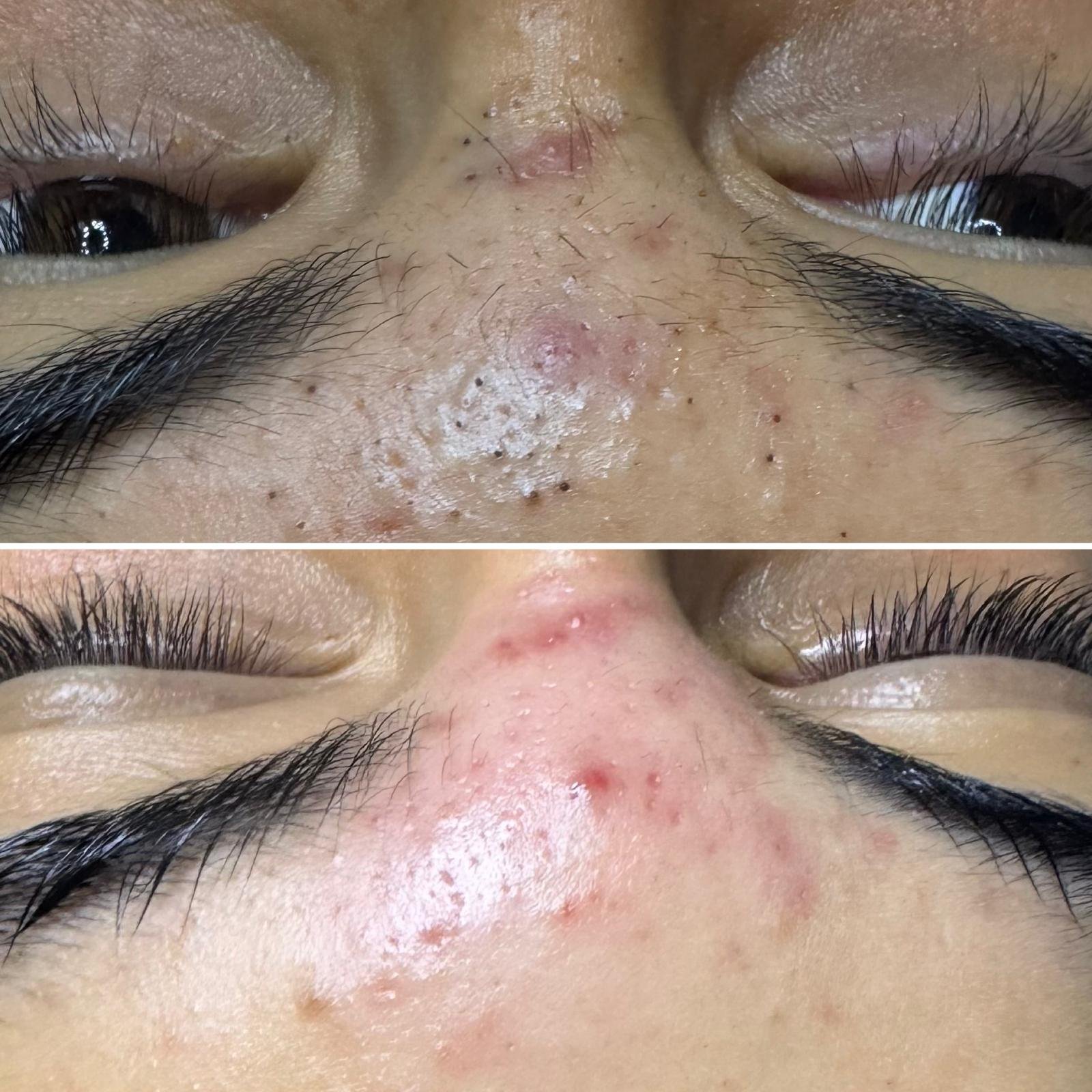 Limpieza Facial Spa Antiacné