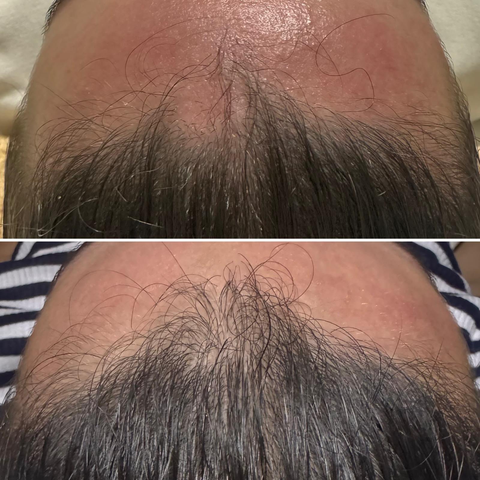 Dermapen Redensificador Capilar